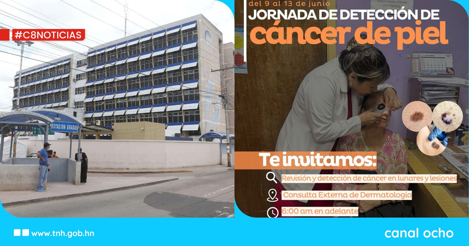 ¡Atención! Hospital Escuela desarrollará Jornada de Detección de Cáncer de Piel