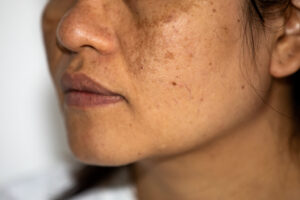 Melasma.