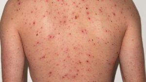 Vacunación Sarampión